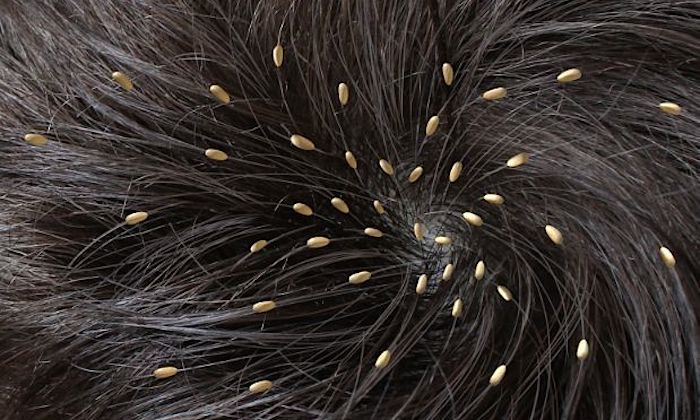 Eek My Child Has Head Lice Sassy Mama