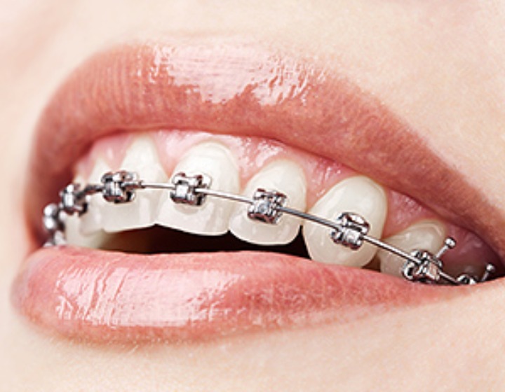 Orthodontist Singapore - Atria City Dental Group - mouth with braces