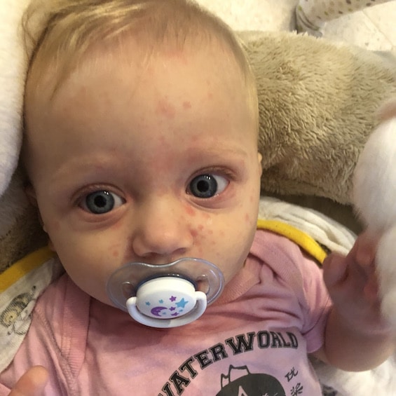 baby erin had measles at 7 months