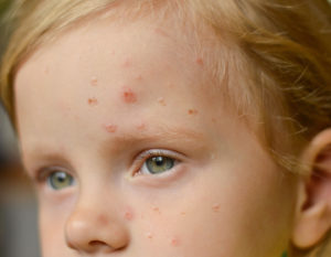 monkeypox in kids in Singapore - symptoms and treatment